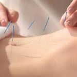 Curso de Acupuntura